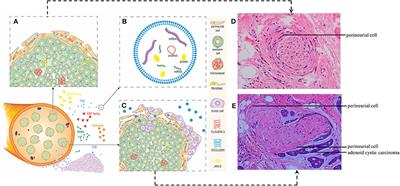 Perineural Invasion in Adenoid Cystic Carcinoma of the Salivary Glands: Where We Are and Where We Need to Go